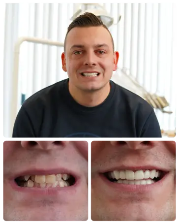 Hollywood Smile transformation — Jordy